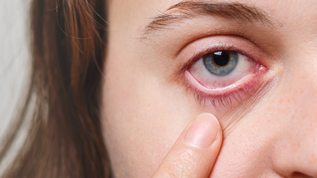 Woman showing her eye that is infected with conjunctivitis, or pink eye