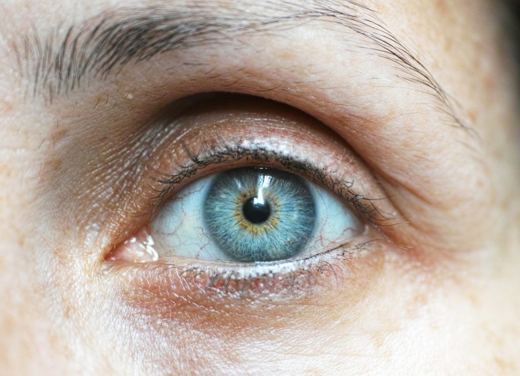 Close up of a middle aged womans eye, she has had refractive lens exchange surgery