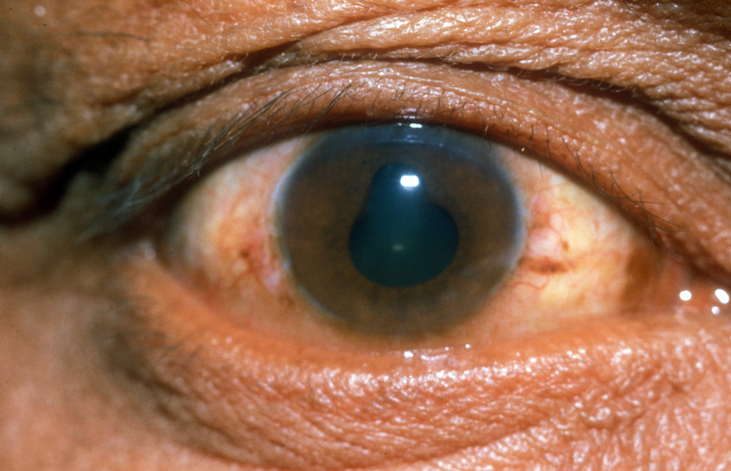 An eye with inflammation due to uveitis