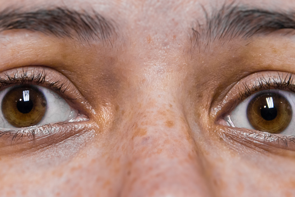 Close up of a persons eyes after having LASIK eye surgery to treat presbyopia